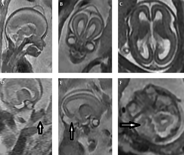 MRI findings of fetal brain at 20 weeks: A and B, Sagittal and coronal view show acrocephaly, scalp cyst, hypertelorism and normal corpus callosum; C, axial view shows mild ventriculomegaly; D, parasagittal view shows mitten glove syndactyly in hand; E and F: parasagittal and axial views show temporal lobe overconvolution.