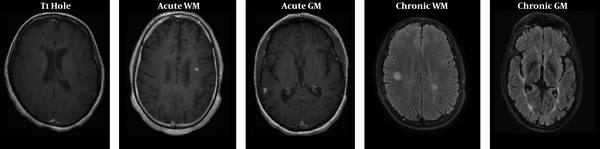Illustration of the lesion appearance of T1 hole in T1-weighted images, acute gadolinium-enhancing white matter (WM) and grey matter (GM) lesions in T1-weighted images, and chronic WM and GM lesions in T2-FLAIR images, respectively.