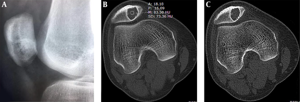 Patellar hemangioma. Plain radiograph (A) and CT scan (B and C) demonstrate an eccentric lesion with well-defined, sclerotic margins. The CT value inside the lesion is relatively high (B) with interior calcification (C). Bone crests are formed at the edge (C). The trochlear groove is shallow and flat with a smaller LPI (lateral pulley inclination).
