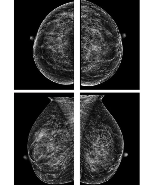 Mammograms, Breast Ultrasounds and MRI's: What's It All Mean?