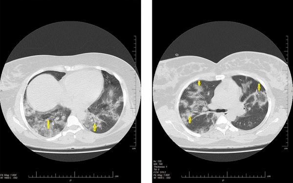 Axial non-contrast HRCT scan of chest shows bilateral diffuse mixed ground glass and alveolar consolidation in left and right upper and lower lobe