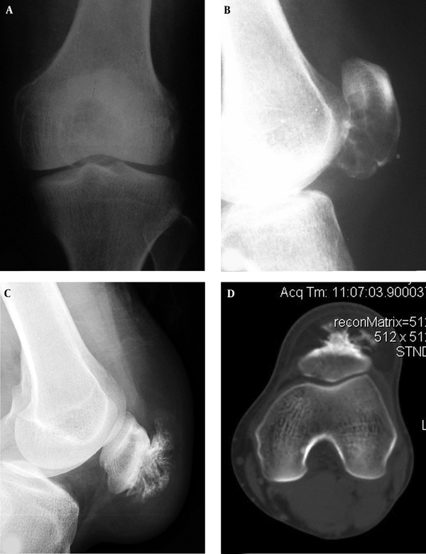 Patellar aneurysmal bone cyst and parosteal lipoma are shown. A and B, The patellar aneurysmal bone cyst demonstrates an expansive lytic destruction area in the lower half of the patella with fine and thin septations inside the lesion. C and D, The parosteal lipoma is shown as soft tissue in front of the patella with fatty density and branches of bone protrusions connected to the patella front part. The trochlear groove is relatively shallow with smaller lateral pulley inclination (LPI) (D).
