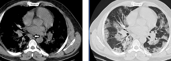 46-year-old man with fever and cough. Axial CT scans in mediastinal (left) and lung (right) window settings show bilateral, multilobar patchy ground-glass opacities. Arrow shows lymphadenopathy, not a typical finding in Covid 19 pneumonia.