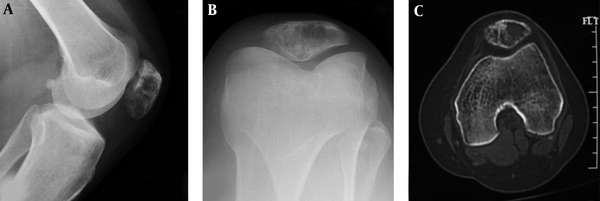 A well-differentiated osteosarcoma is shown in the patella. A and B, Radiographs demonstrate decreased density in the lower extremity of the patella with interrupted cortex. C, Computed tomography reveals expansive lytic destruction with thinned cortex and interrupted cortex in the interior bottom similar to a benign lesion. The trochlear groove is relatively shallow with a smaller LPI (lateral pulley inclination).