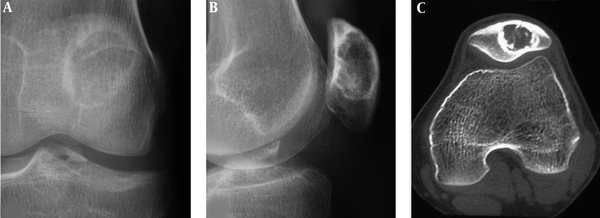 A patellar chondroblastoma is demonstrated in a 19-year-old boy who had knee pain for 2 years. Plain radiographs (A and B) and computed tomography (C) shows a lucent lesion in the left patella with sclerotic rims, inhomogeneous density and irregular calcification inside the lesion. The trochlear groove is shallow (C).