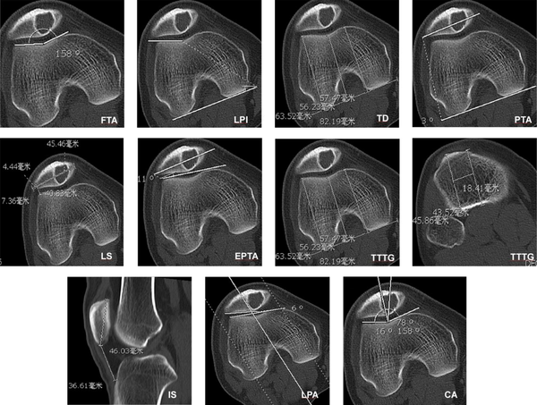 Measurement of morphological data of the patella with a hemangioma lesion. FTA, femoral trochlear angle; LPI, lateral pulley inclination; TD, trochlear depth; PTA, patellar tilt angle; LS, lateral shift; EPTA, external patellar tilt angle; TTTG, tibial tuberosity-trochlear groove distance; IS, Insall-Salvati; LPA, lateral patello-femoral angle; CA, congruence angle