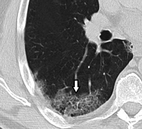A 55-year-old woman with fever, cough, and myalgia. Axial CT of the right lung shows peripheral ground-glass opacity with a crazy-paving pattern (Arrow).