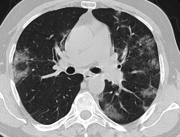 43-year-old man with fever and dry cough. Axial CT image shows bilateral, multilobar, patchy ground-glass opacities.
