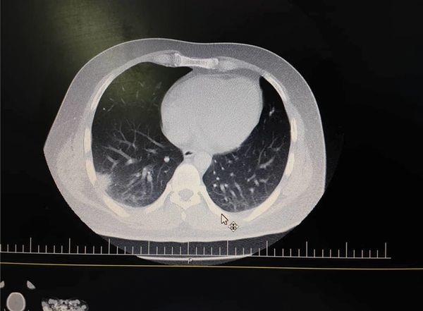 Lung CT scan of the patient