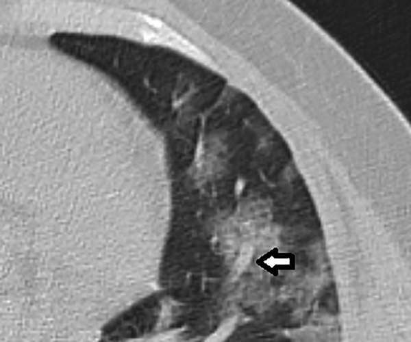 A 45-year-old man with a cough. Axial CT of left lung shows ground-glass opacity with vascular thickening (Arrow).