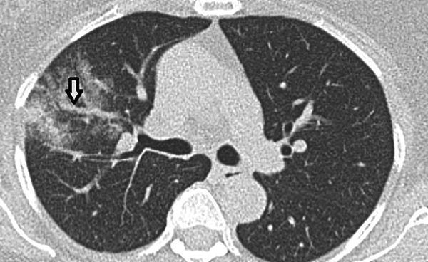 A 45-year-old man with fever, dry cough, and fatigue. Axial CT shows ground-glass opacity with vascular thickening (Arrow).