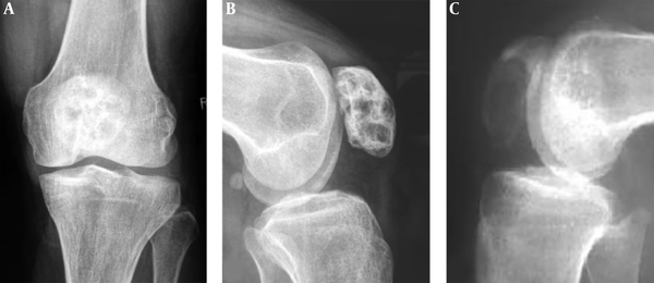 Patellar fibrous dysplasia and bone cyst are demonstrated. A and B, Plain radiographs reveal inhomogeneous destruction like a beehive in the patella with coarse septations and high density inside the lesion. C, A patellar bone cyst demonstrates it as lytic destruction with relative homogeneous density inside the lesion.