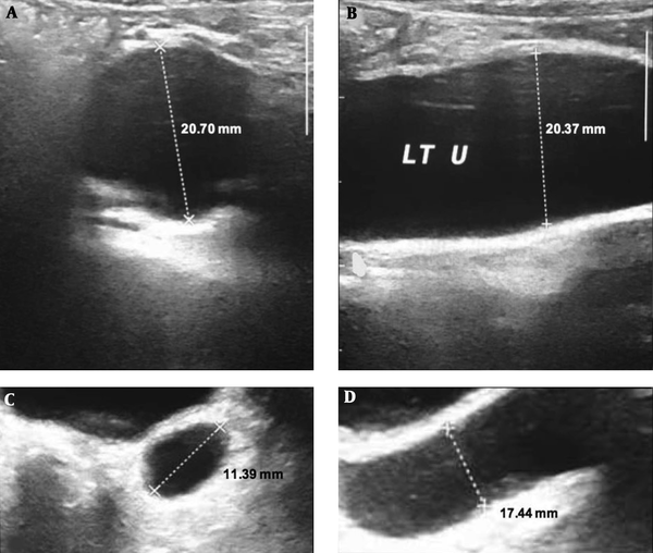 In part A and B patient’s left ureter is displayed prior to free drainage and as labeled, the size of ureter is measured in two views, in part C and D patient’s ureter is demonstrated following two hours of free drainage and as labeled, the ureter size is again measured and there is significant decrease in the caliber of ureter.
