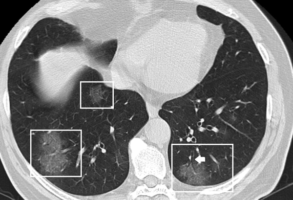 A 56-year-old man with fever and cough. Axial CT shows bilateral, multilobar, ground-glass opacities with air bronchogram (White arrow).