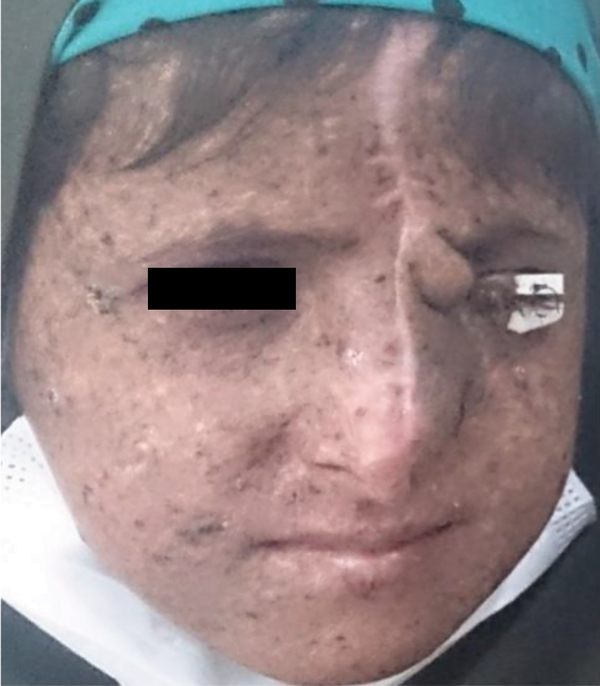 Numerous hyperpigmented macules and freckle-like lesions on the face, squamous cell carcinoma on the forehead, and basal cell carcinoma on the tip of the nose.