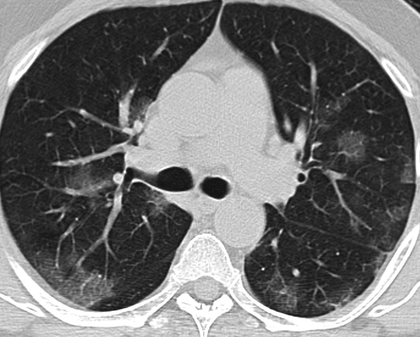 A 65-year-old man with fever and myalgia. Axial CT scan shows bilateral patch and round ground-glass opacities.