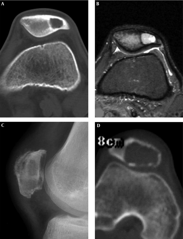 Patellar chondroblastoma and giant cell tumor are shown. A and B, A 19-year-old boy with left knee pain for two months. A, A round bone destruction area is shown with slight sclerotic rims and homogeneous density inside the lesion. B. The short tau inversion recovery (STIR) sequence of magnetic resonance imaging revealed the lesion to be long T2 weighted image signal with inhomogeneous signal, clear rims and effusion inside the joint capsule. C and D, A giant cell tumor is shown in the irregular patella with a lytic destruction area and swelling joint capsule (C). D, Computed tomography shows an eccentric bond destruction area with expansive thinned cortex. The trochlear groove is shallow, the medial and lateral pulley inclination (LPI) is small, and the lateral pulley joint surface is longer.