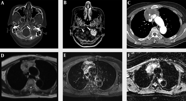 A 60-year-old woman with primary thymic mucinous adenocarcinoma presented with dysarthria due to metastasis to the skull base. A, In the brain CT with bone window setting, an osteolytic lesion (arrowhead) of about 2.5 cm in size is observed in the left lateral part of the occipital bone and petrous apex, and this lesion is invading the left hypoglossal canal (arrow). B, In contrast-enhanced (CE) brain MRI, there was approximately 2.5 cm homogeneous enhancing lesion in the left lateral part of occipital bone and petrous apex, invading the left hypoglossal canal (arrow). C, A heterogeneous enhancing mass of about 6.9 cm was observed in CE Chest CT, with central low attenuation and focal calcification. D-E, Chest MRI showed that this mass had a heterogeneous high signal intensity in the T2-weighted image (D), heterogeneous enhancement in the CE T1-weighted image, and invasion of adjacent superior vena cava and both innominate veins. F, The peripheral portion of this mass shows a low apparent diffusion coefficient value.