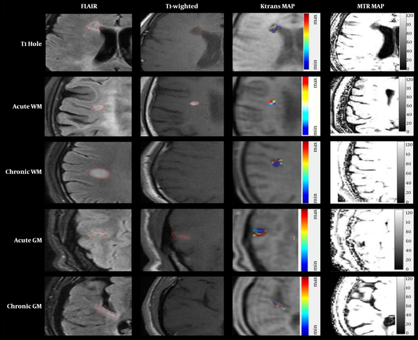 Left columns, Lesions in two MRI-modalities of T2-FLAIR and T1-weighted images; right columns, Ktrans and MTR map with their color bar in the FLAIR and T1-weighted images. The lesions are displayed by red markers.