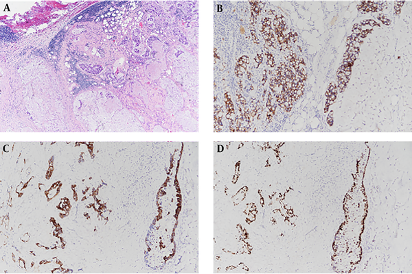 A, Microscopic findings of the anterior mediastinal mass. Hematoxylin and eosin (H & E) staining reveals nests and clusters of atypical tumor cells float in pools of extracellular mucin (H & E, 40×). B-D, Immunohistochemical stains reveal strong immunoreactivity for CK7, CK20 and CDX2 (100×).