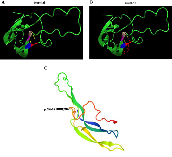 The prediction of the tertiary structure of TSHβ protein by PYMOLE for the normal and mutant variant (p.G106R mutation). A, The results of this model show that glycine connects with valine and cysteine with two bonds. B, In the mutant protein, arginine binds to the two amino acids of cysteine and one valine with three bonds. C, The position of p.G106R mutation in TSHβ protein indicated that this mutation is part of a coil structure.