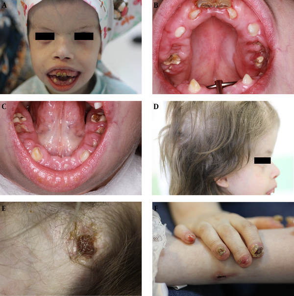 A, Anterior open bite and skew deviation of the left eye; B, maxillary arch; Embedded teeth in the hyperplastic gingiva and carious lesions; C, mandibular arch; embedded teeth in the hyperplastic gingiva and carious lesions; D, depressed nasal bridge, Small low set ears, prominent forehead, thin and sparse hair; E, alopecia and large crusted ulcer on scalp; F, dystrophic nails.
