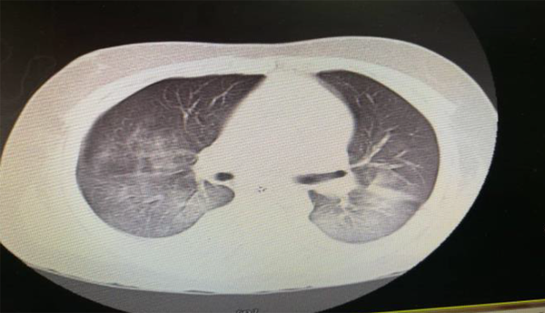 Chest CT-scan of the patient