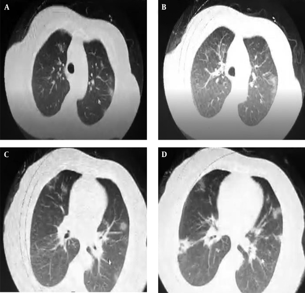 Chest imaging of the patient. (A-D) Chest CT taken on March 17, 2020 (four days after the symptom onset, the same day, the patient was admitted to the hospital) shows bilateral ground-glass opacities.