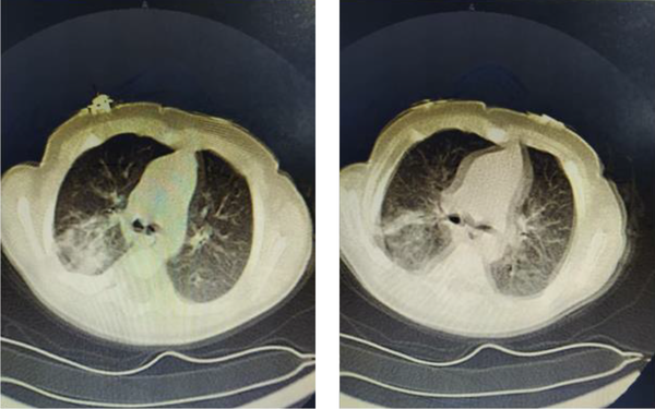 The chest CT-scan of the patient is shown