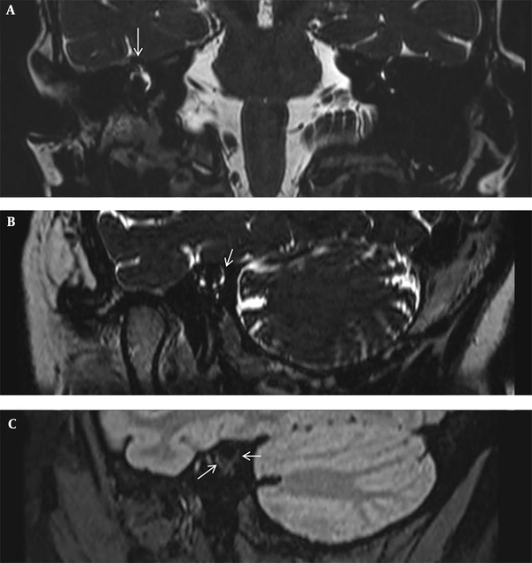 Postoperative magnetic resonance imaging (MRI) of the patient after plugging surgery. A, 3D T2-weighted sampling perfection with application optimized contrasts using different flip angle evolution (SPACE) image in the coronal plane at the level of the superior semicircular canal (SCC) shows an intact right superior ampulla (arrow). B, 3D T2-weighted SPACE image in the Pöschl plane shows a filling defect of the superior canal, but a residual perilymphatic fluid signal exists in the posterior limb of SCC, above the fenestration site (arrow). C, Post-contrast three-dimensional fluid-attenuated inversion recovery (3D-FLAIR) image shows faint enhancement of the right ampulla, SCC and vestibule, thereby suggesting labyrinthitis (arrows).