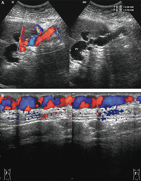 Portal-umbilical shunt. A, Sonograms show that blood from the left sagittal branch of the portal vein flows to the recanalized umbilical vein. The umbilical vein is dilated, with a diameter of 1.14 cm; B, Color Doppler sonograms show tortuous and dilated superficial periumbilical epigastric veins.