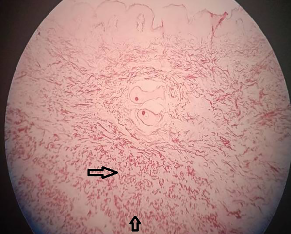 Orcein stain: 10x view showing fragmented elastin fibers in the mid dermis (elastorrhexis)
