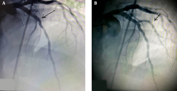 Angiography and primary percutaneous intervention indicating A, occlusion of the artery that B, was treated with the REVERSE modified flower petal stenting technique.