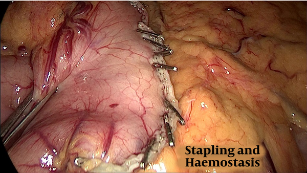 Stapling and hemostasis