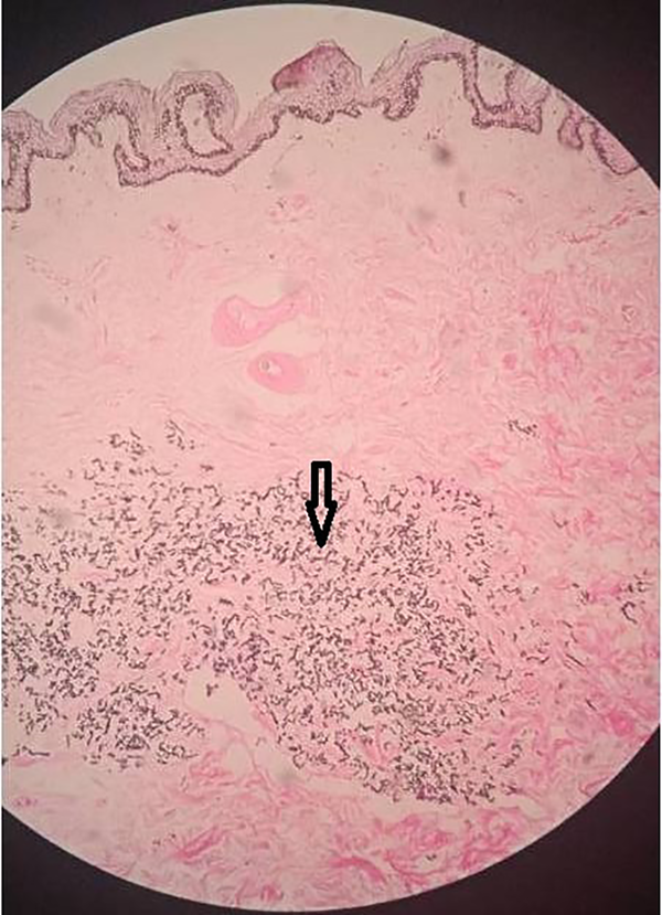 Von Kossa stain: 10x view showing calcification of elastin fibers in the mid dermis