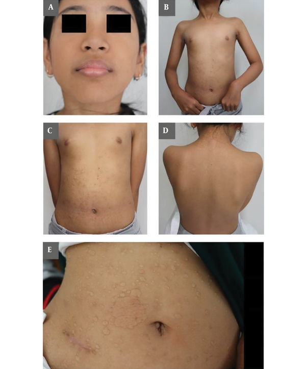 Photographic depictions of anetoderma
