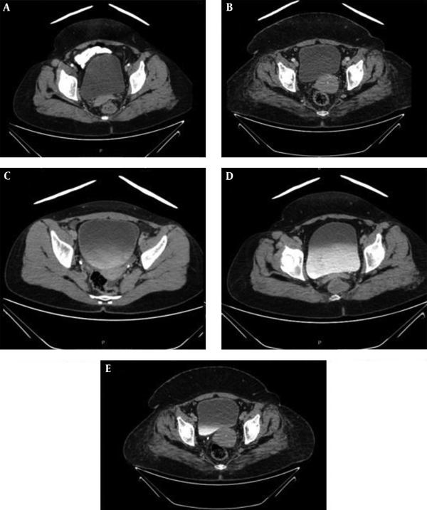 examples of pelvic CT images without and with 1T shields thicknesses. A, 100% Bi; B, 90% Bi-10% Cu; C, 50% Bi-50% Cu; D, 10% Bi-90% Cu; E, without shielding.