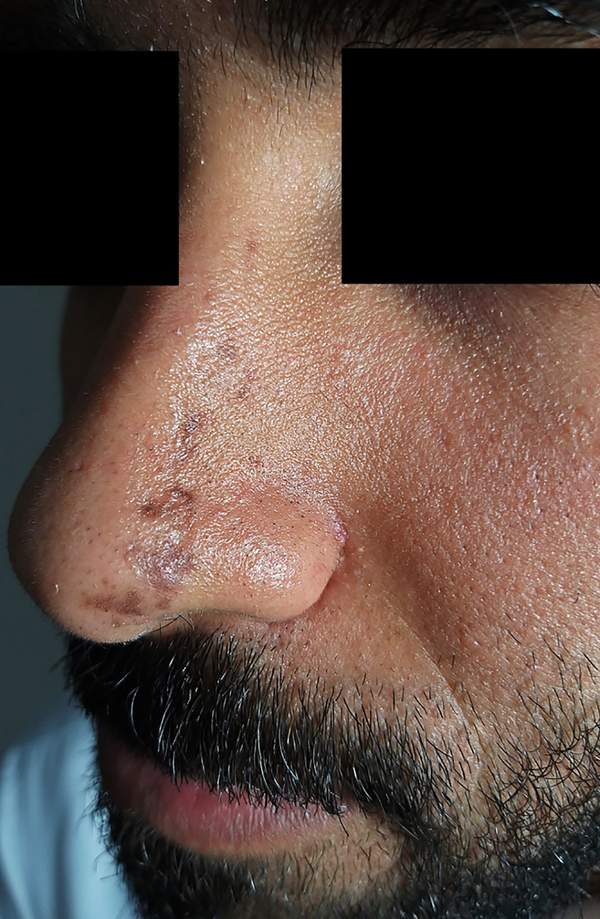 Multiple hyperpigmented atrophic lesions present in a band like pattern over left side of nose following Blaschko lines.
