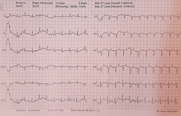 The ECG of stage 3 of the exercise stress test showing no change in cardiac function