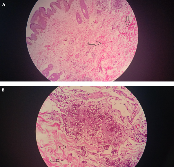 A, Hematoxylin and eosin stain: 10x view showing fragmented elastin fibers in the mid dermis. B, Hematoxylin and eosin stain: 40x view showing fragmented elastin fibers in the mid dermis