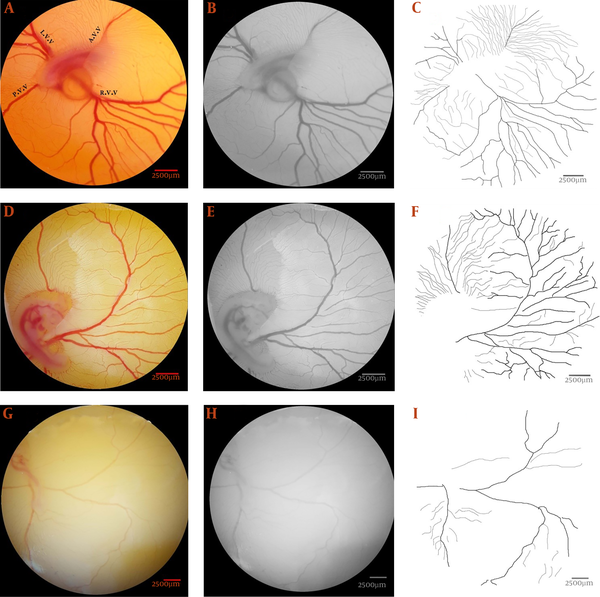 The vascular plexus of the day four embryos are presented to illustrate the image manipulations required for vascular branching pattern analysis. The images are captured from the embryo of the control (a - c) and Teucrium polium at dosages of 3 (d - f) or 6 (g - i) mg per kg egg-weight. (a, d, and g) A particular area, 315 mm2 containing 2987 × 2987 pixels, was identified at the right-lateral vitelline vascular plexus. (b, e, and h) The extracted areas were converted into an 8-bit format. (c, f, and i) The vascular branching pattern was ascertained from the skeletonized pictures.