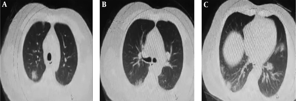 Chest imaging of the patient. (a-c) Chest CT shows peripheral ground-glass opacities.