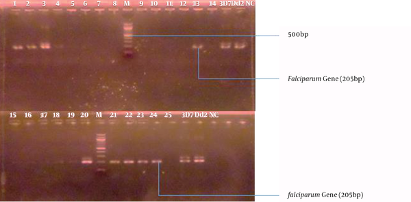 Agarose Gel electrophoresis of Plasmodium falciparum gene isolated from positive and negative malaria samples. Lanes 1-14 and 15-25 represent the samples. Lane M is the 100 bp molecular ladder; 3D7 and Dd2 are the positive controls, while NC is the negative control.