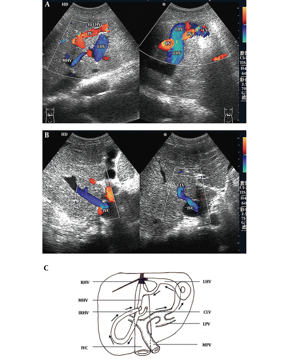 Portal-accessory hepatic venous shunt. A, Color Doppler sonogram shows that the blood from the portal vein (PV) flows to the left hepatic vein (LHV) through the communicating vessel (CV) (right hand image) and onward to the middle hepatic vein (MHV) (left hand image) via communicating branches (arrow); B, Color Doppler sonograms show that blood drains into the inferior vena cava (IVC) by the dilated inferior right hepatic vein (IRHV) (left hand image) and caudate lobe vein (CLV) (right hand image); C, Diagram of a portal-accessory hepatic shunt shows segmental occlusion of the LHV, MHV, and IVC, and complete occlusion of the right hepatic vein (RHV). Blood from the left portal vein (LPV) flows into the LHV and MHV through the CVs and then drains into the IVC through the IRHV and CLV.