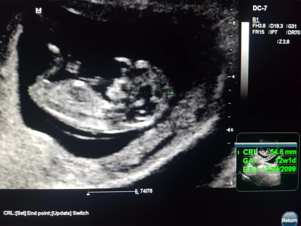 Ultrasound of male fetus at 13 weeks