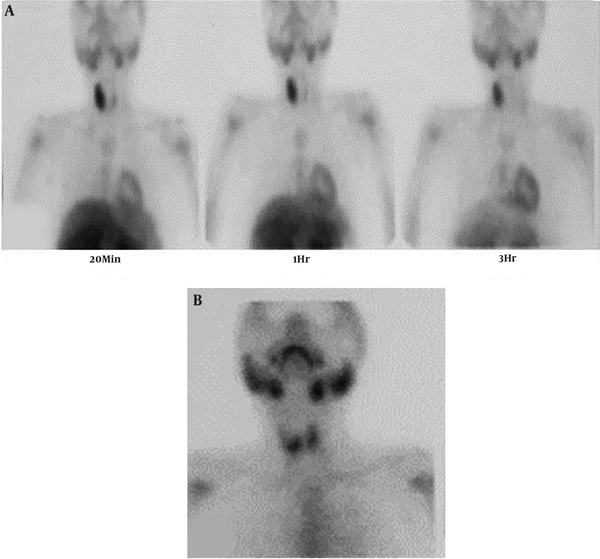 A, Parathyroid sestamibi scintigraphy in early (20 min) and delayed (1 and 3 hr.) phases; B, thyroid scintigraphy two days after parathyroid scan