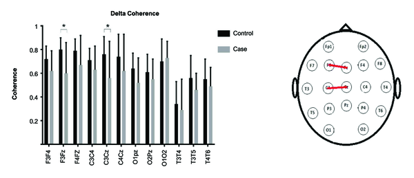 Delta coherence of electrode pairs in frontal, parietal, occipital, and temporal lobes, * denotes a significant difference at α=0.05.