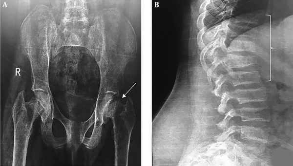 A, Pelvic plain radiography shows femoral neck fracture; B, thoracic and lumbar spine pain radiography demonstrated vertebral wedge fracture.