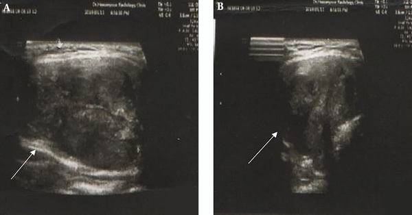 A, Ultrasonography shows large thyroidal nodule; B, intra nodular hyper and hypoechogenesity