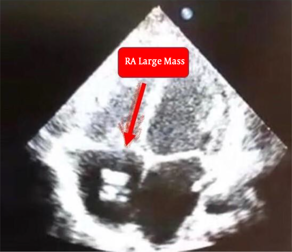 A large 20 mm right atrial mass in transthoracic echocardiography